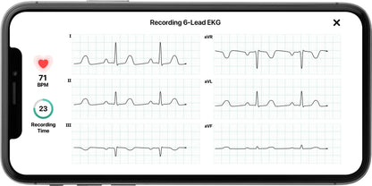 KardiaMobile 6L Personal EKG Monitor With Most Smartphones